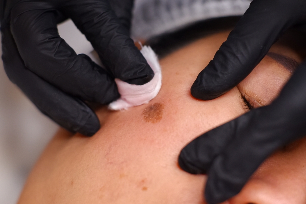 melasma specialist near Kennesaw Georgia