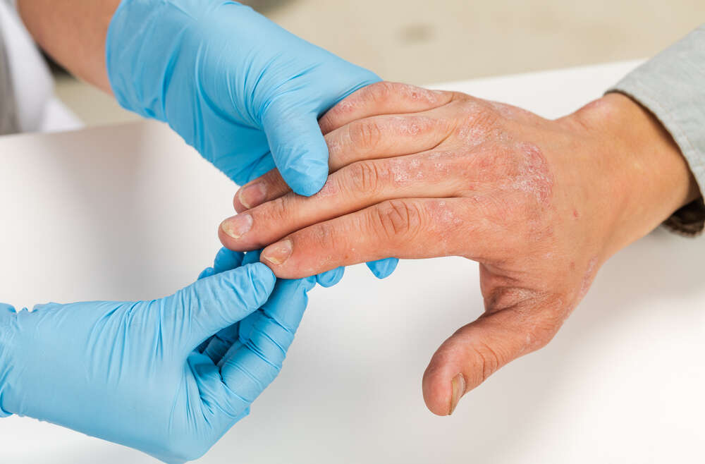 When to See a Psoriasis Specialist Near Kennesaw, Georgia