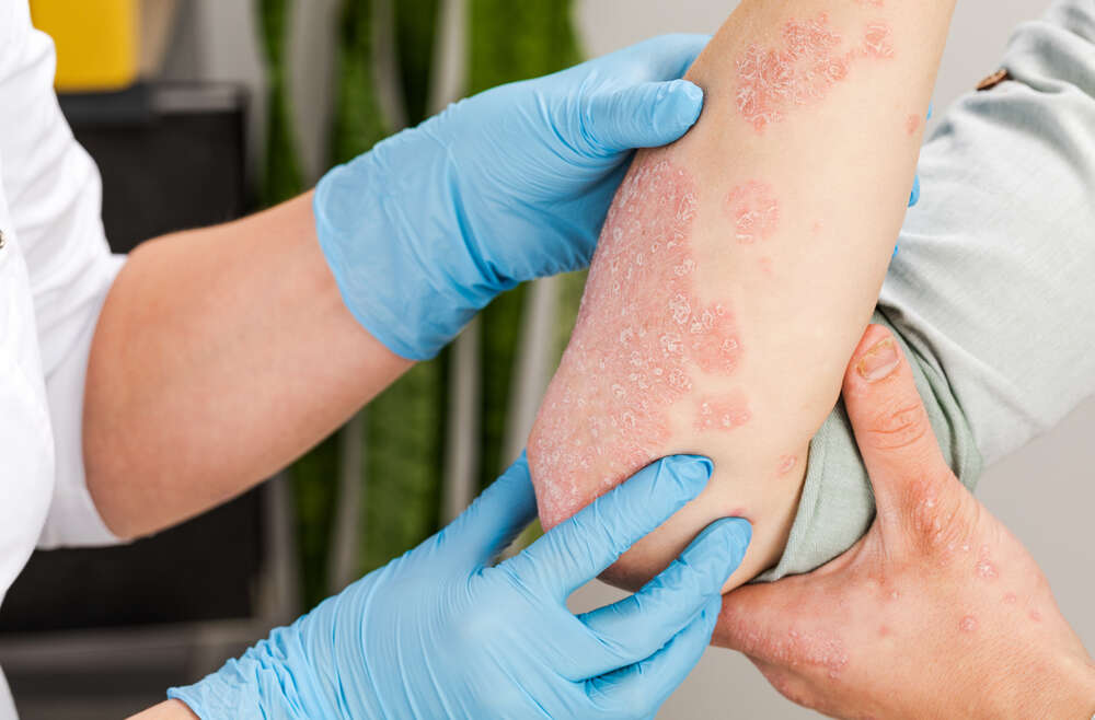 When to See a Psoriasis Specialist Near Marietta, Georgia