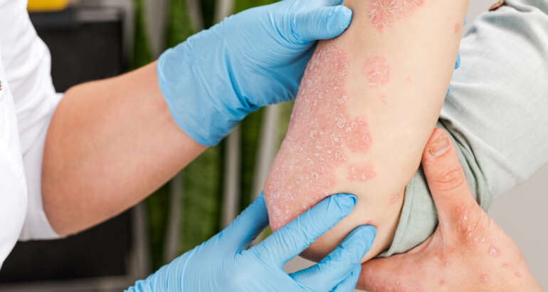 When to See a Psoriasis Specialist Near Marietta, Georgia