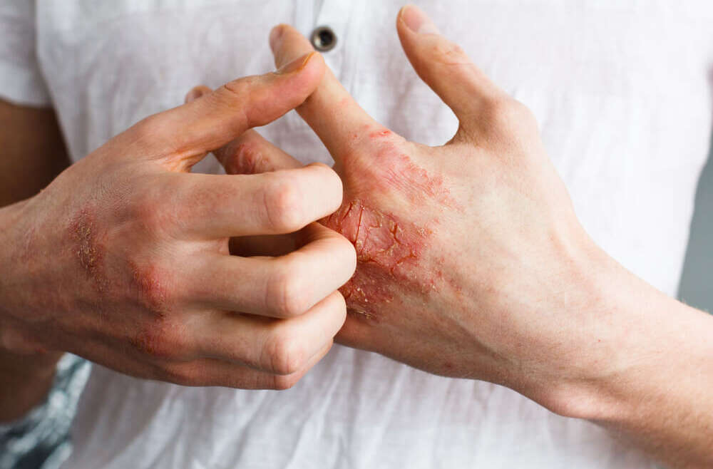 How to Diagnose and Treat Psoriasis Near Alpharetta, Georgia