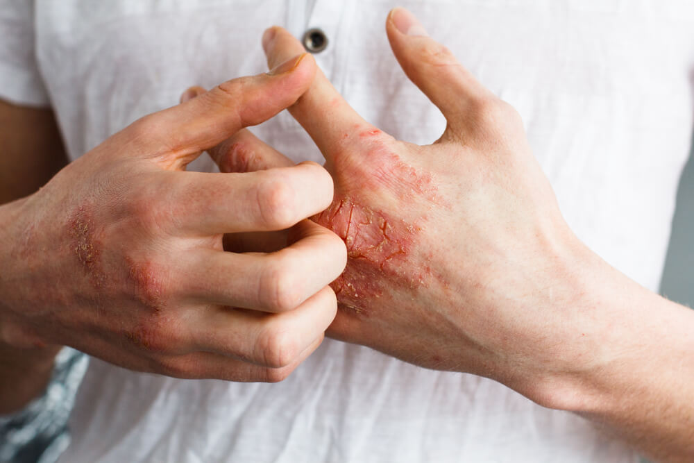 Psoriasis Alpharetta Georgia