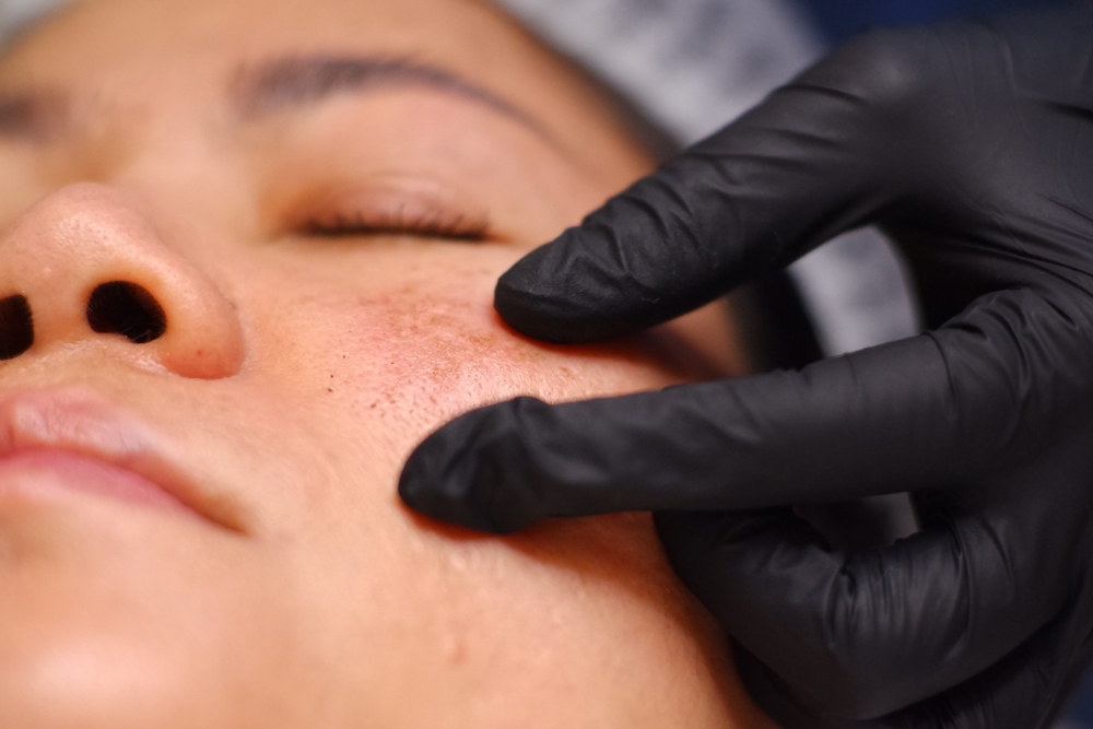 Why You Should Visit a Melasma Specialist Near Smyrna, Georgia