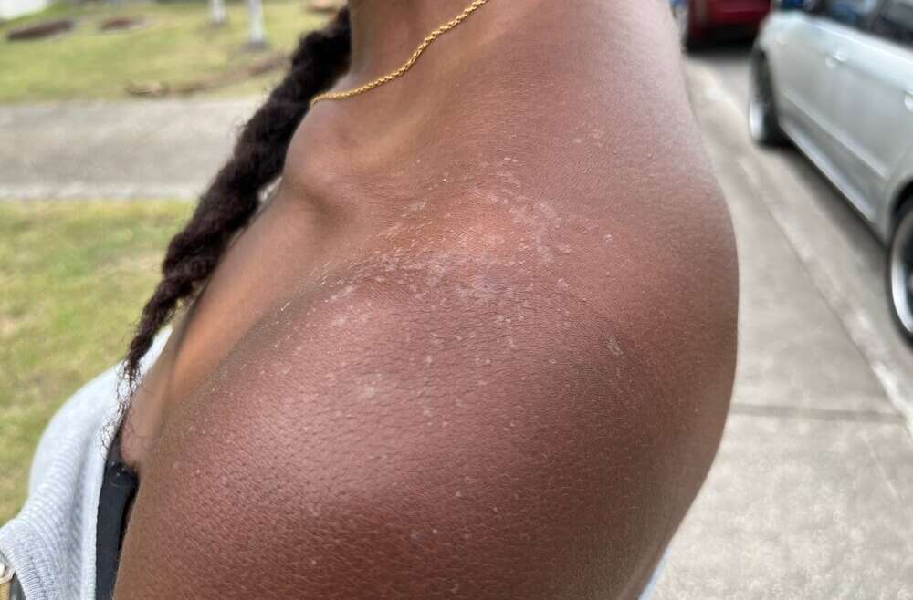Sunburn on Black Skin in Georgia: What It Looks Like and How to Protect Melanin
