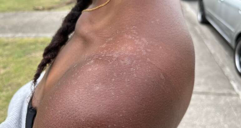 Sunburn on Black Skin in Georgia: What It Looks Like and How to Protect Melanin
