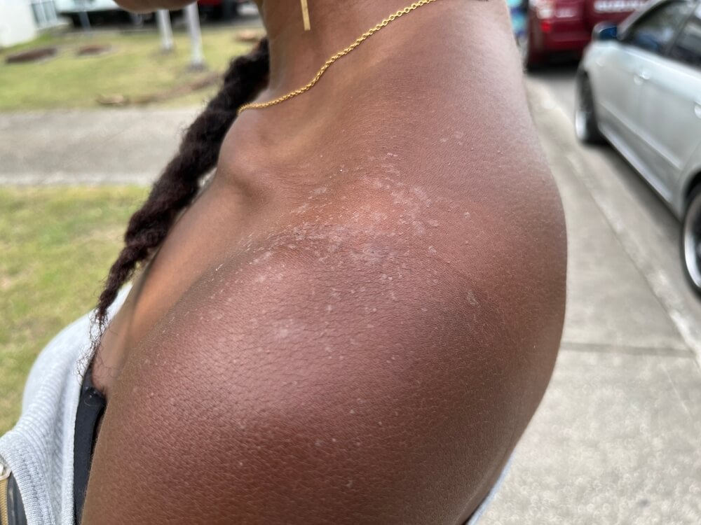 sunburn on black skin in Georgia
