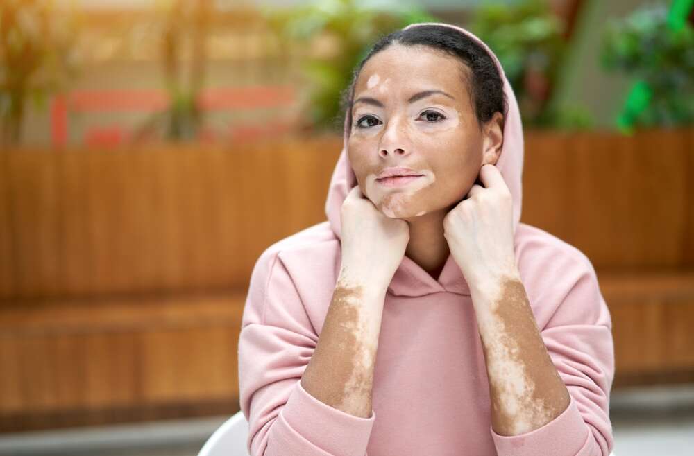 A Guide to Vitiligo in Acworth, GA: Causes, Treatments & More