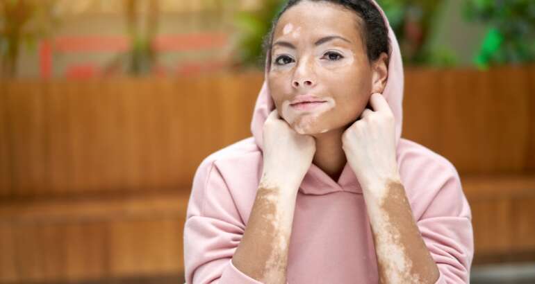 A Guide to Vitiligo in Acworth, GA: Causes, Treatments & More