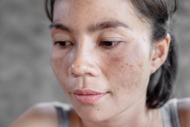 Melasma Near Marietta, GA: How to Diagnose and Treat It