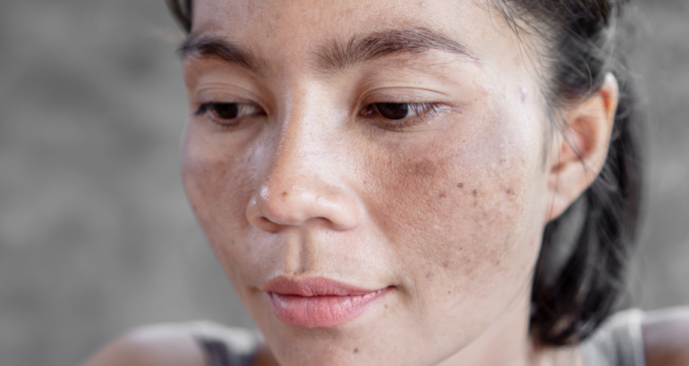 Melasma Near Marietta, GA: How to Diagnose and Treat It