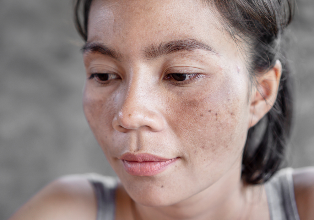 woman with melasma near Marietta GA