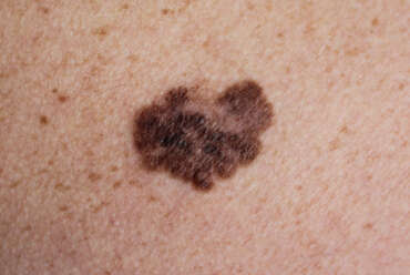 Types of Skin Cancer Treated With Mohs Surgery