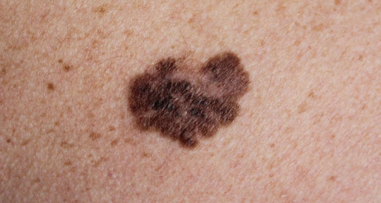 Types of Skin Cancer Treated With Mohs Surgery