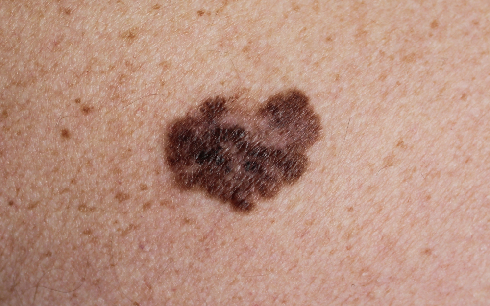 Types of Skin Cancer Treated With Mohs Surgery