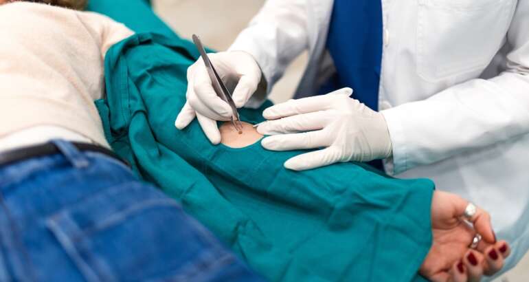 Skin Biopsies in Acworth: A Guide for Georgia Residents