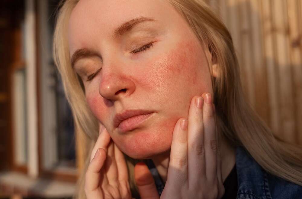 Rosacea Treatment Near Woodstock, GA: What Actually Calms the Redness