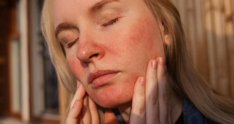Rosacea Treatment Near Woodstock, GA: What Actually Calms the Redness