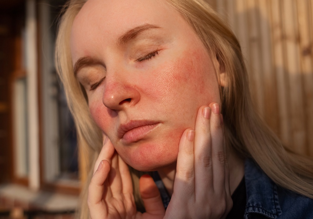 woman in need of rosacea treatment near Woodstock GA